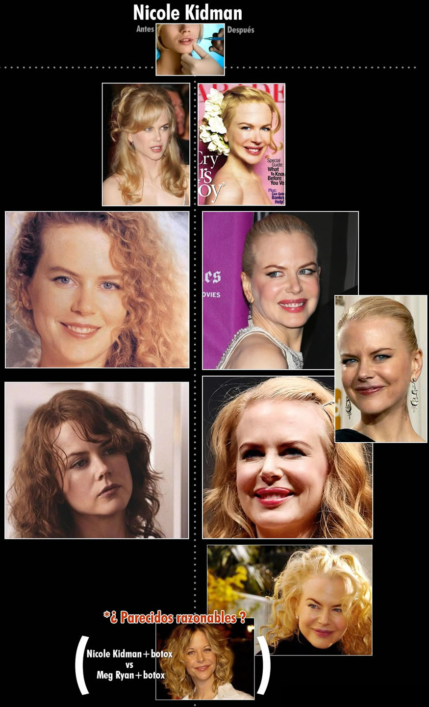 bisturi-nicole-kidman